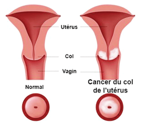 Le cancer du col de l’utérus prend naissance dans les cellules qui tapissent la partie inférieure et étroite de l’utérus. Il s’agit de l’un des cancers les plus couramment diagnostiqués. Cependant, les femmes qui se soumettent régulièrement à un test de Pap (= frottis cervical) sont souvent diagnostiquées et traitées à temps. Ce cancer évolue habituellement lentement et la grande majorité des femmes traitées guérissent complètement. (DR)